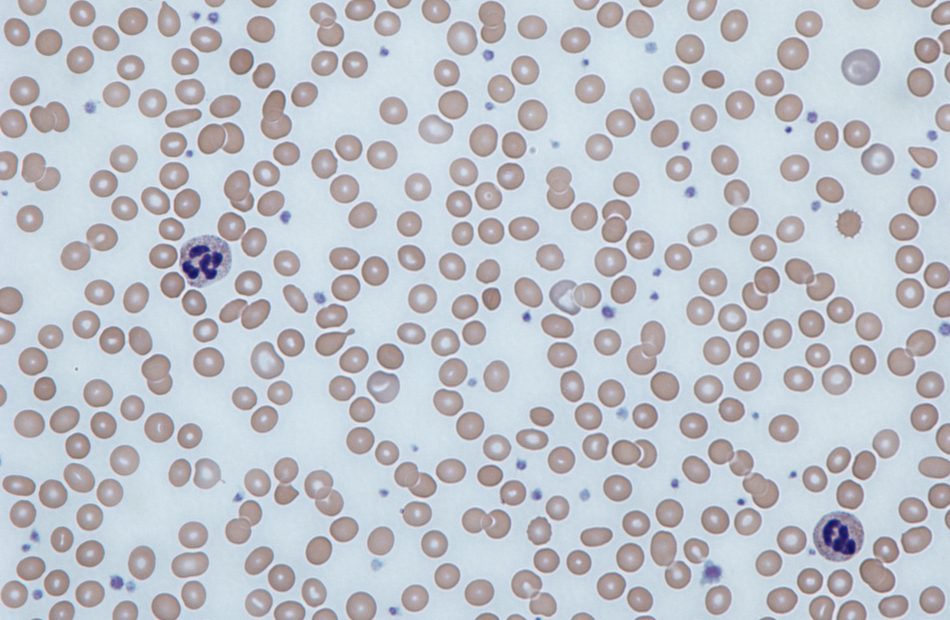 Iron_deficiency_anemia_blood_film